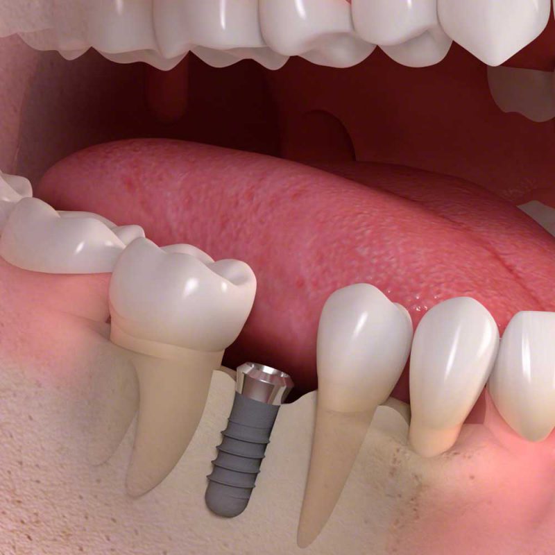 Dental Implants - long term tooth replacement Bexhill-on-Sea