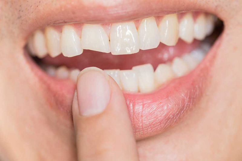 fractured-tooth-treatment Dental Problems - Fractured or broken teeth treatment