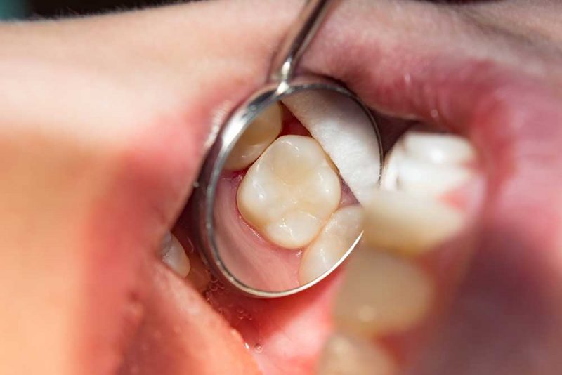 gum-disease-treatment-bexhill Gum Disease Identification and Treatment